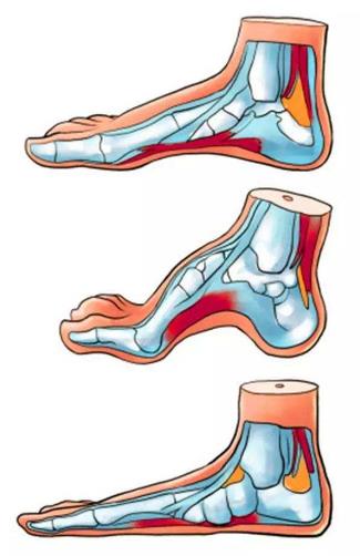 扁平足能跑步吗？扁平足跑步有什么危害？